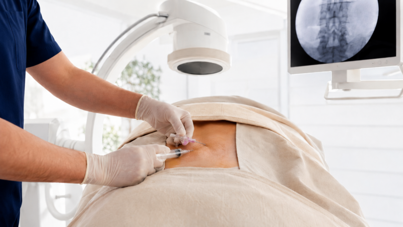 Understanding Lumbar Epidural Steroid Injections. A Patient Guide for Sciatica and Low Back Nerve Pain